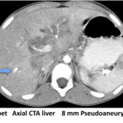 Tumor-Shot